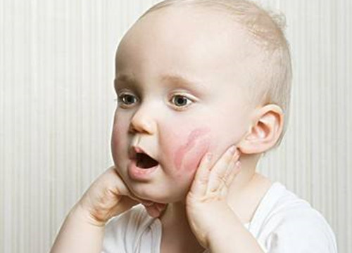 宝宝皮肤过敏怎么办 如何预防宝宝皮肤过敏_母