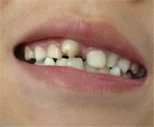 小孩换牙齿吃什么好 换牙的四大注意事项_母婴