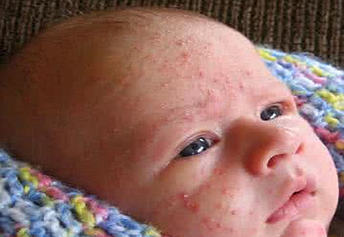 婴儿痤疮和湿疹的区别 预防痤疮和湿疹该怎么