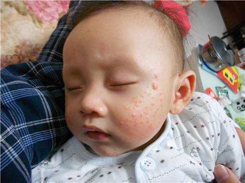 宝宝脸上湿疹是什么引起的 宝宝满脸湿疹用什