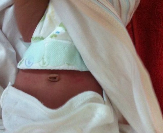 新生儿肚脐正常愈合图图片
